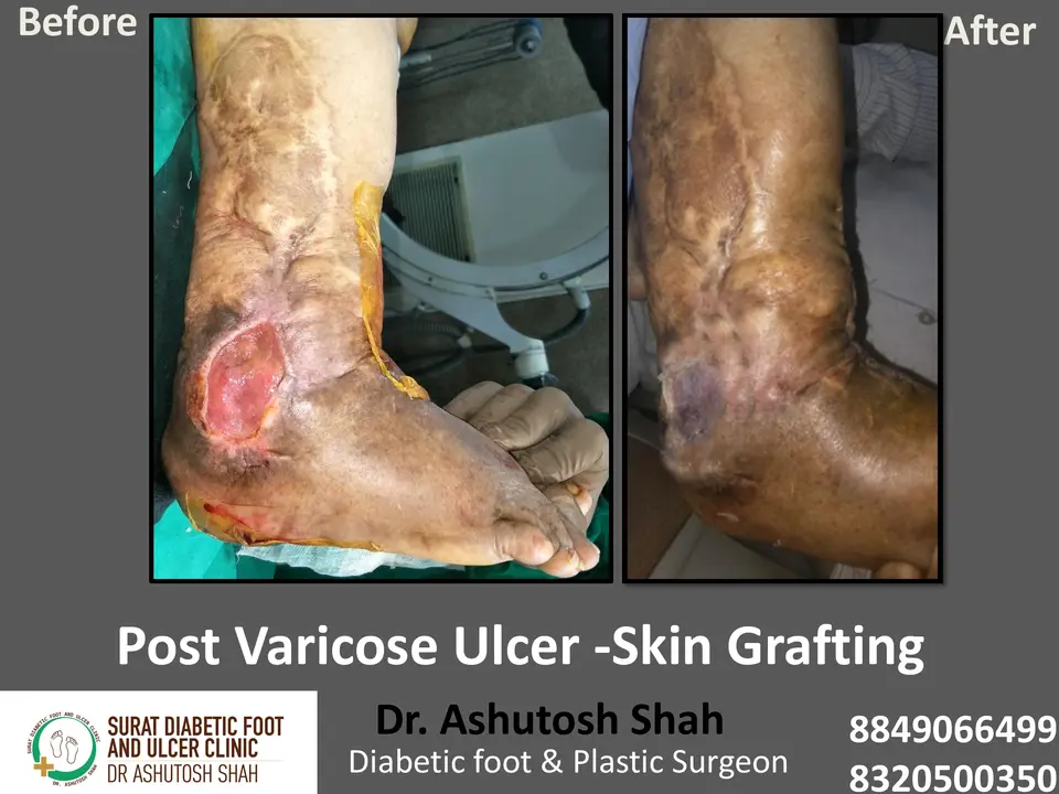 Diabetic Foot  PPT 3 checked by sir.pptx-48.webp